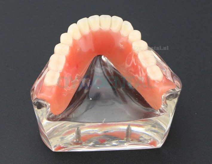 Tandentandenmodel Overdenture Inferieur met 2 implantaten Studiedemo Model 6002 01